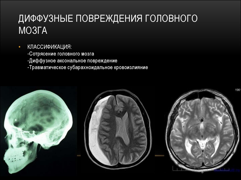 Диффузная травма мозга