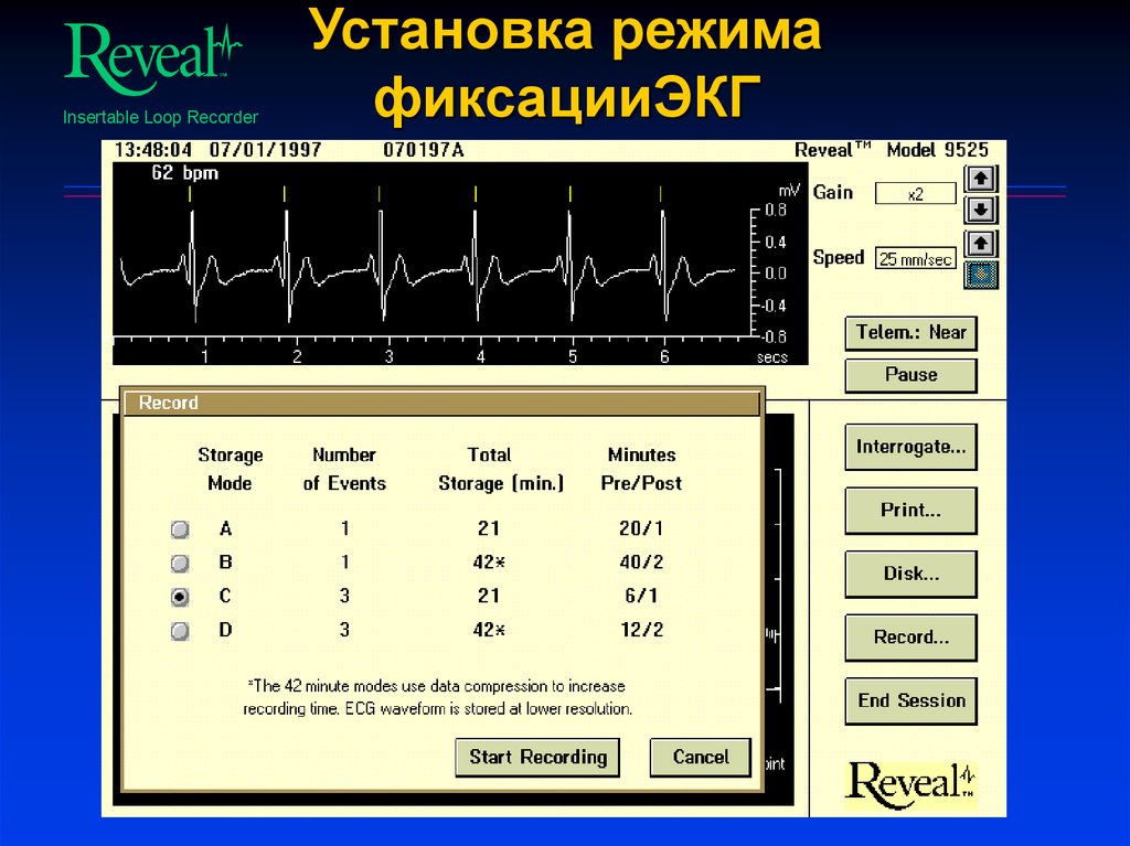 Установка режим. Установившийся режим график. Режим установки. Регистратор ритма. Регистратор ритма сердца.