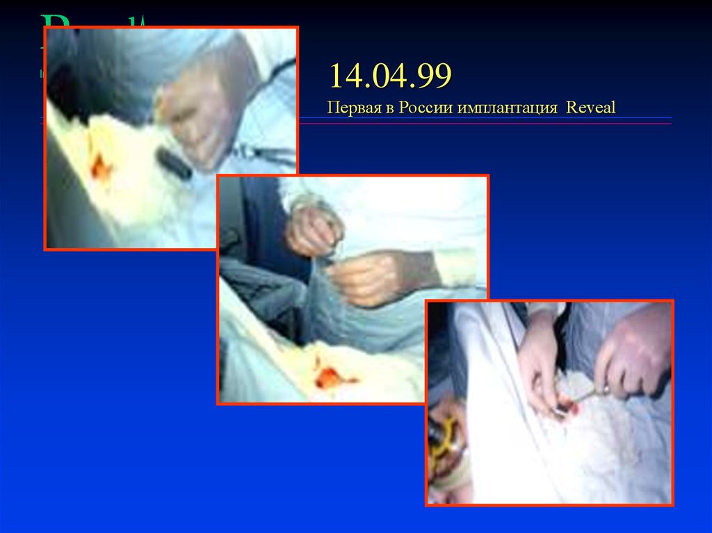 14.04.99 Первая в России имплантация Reveal