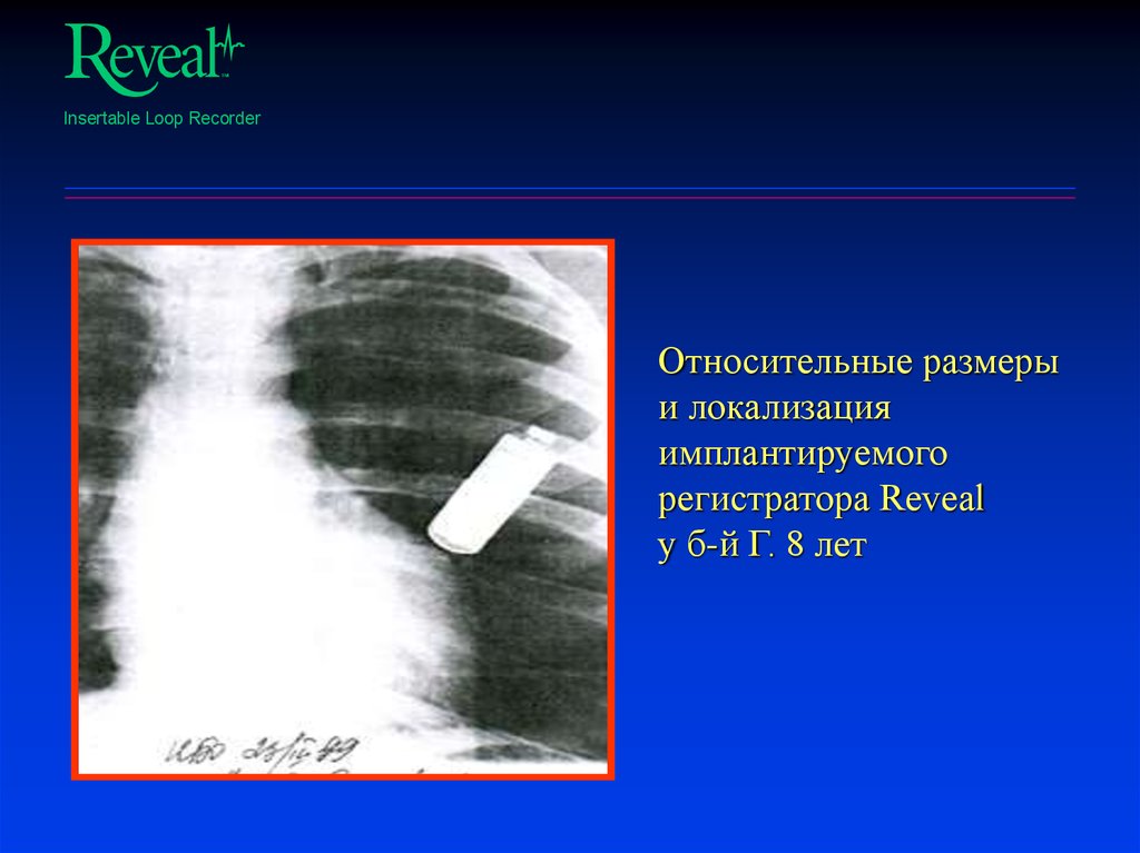 Относительные размеры и локализация имплантируемого регистратора Reveal у б-й Г. 8 лет