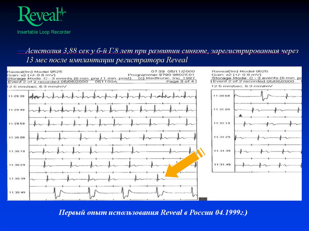 Асистолия 3,88 сек у б-й Г.8 лет при развитии синкопе, зарегистрированная через 13 мес после имплантации регистратора Reveal