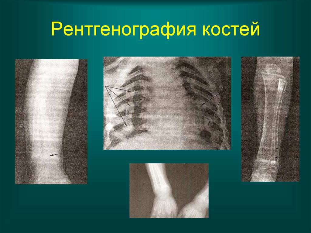 Рентгенологическая картина в период разгара рахита характеризуется