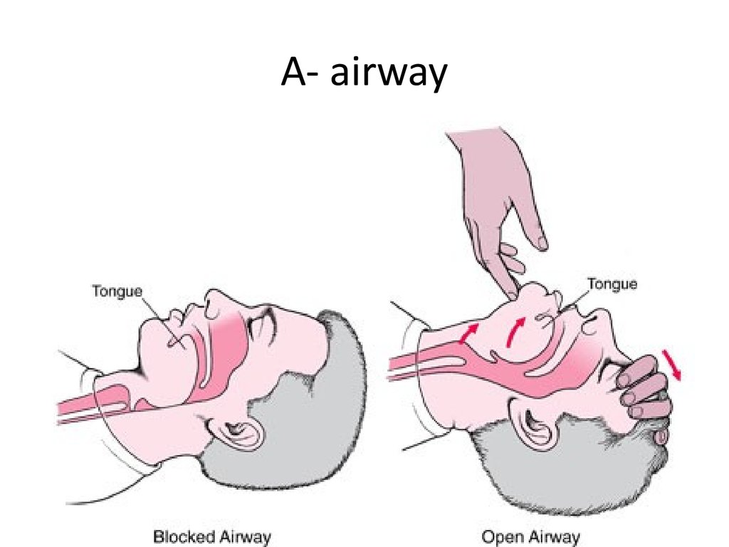 A- airway