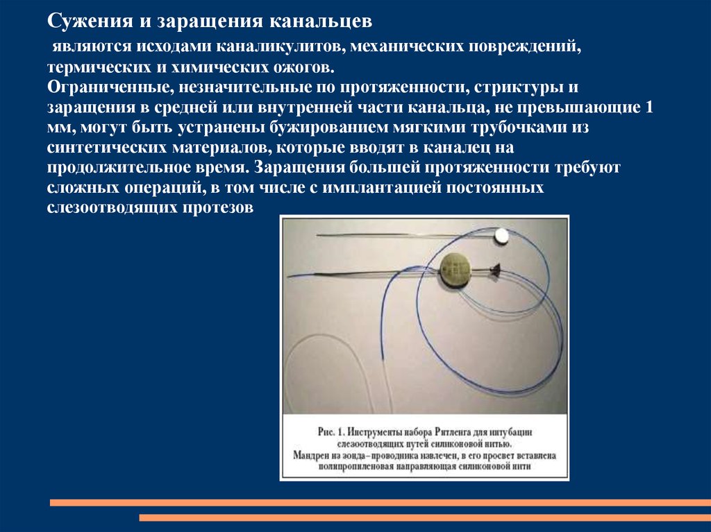 Катетер презентация. Зонд конический для слезного канальца. Зонд Квикерта для интубации слезных канальцев.