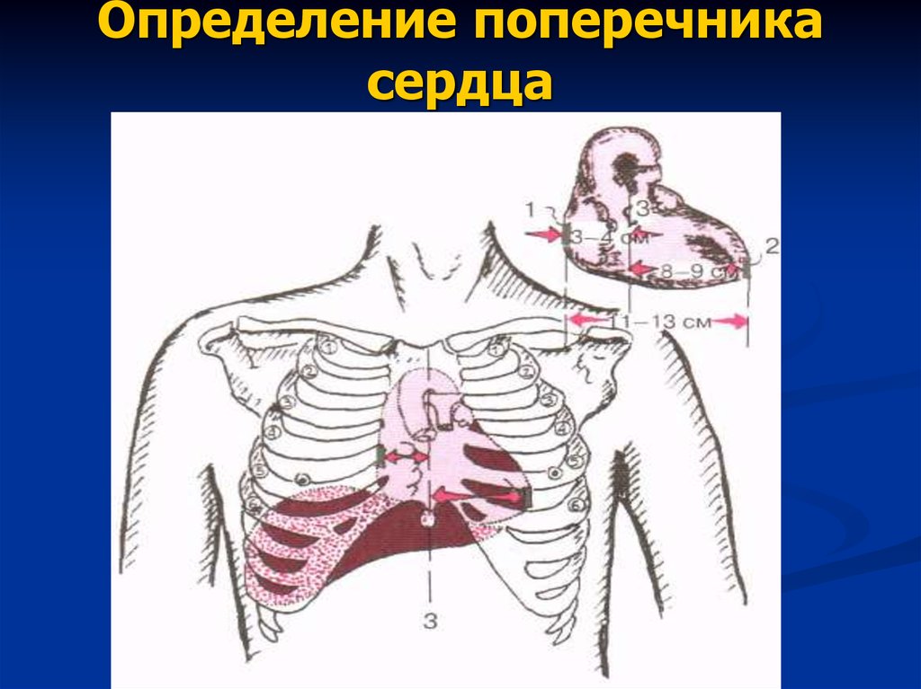 Поперечник. Поперечник относительной тупости сердца в норме. Конфигурацию, длинник и поперечник сердца.. Измерение диаметров и поперечника сердца. Расширение сердца в поперечнике.