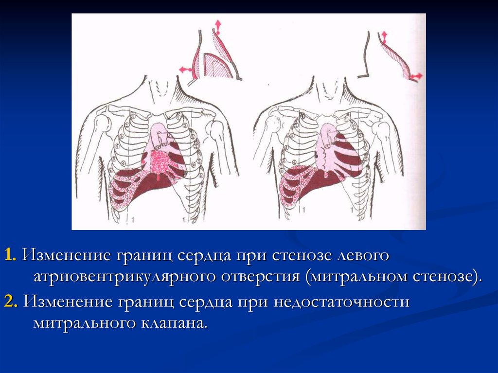 Митральное сердце. Абсолютная тупость сердца при митральном стенозе. Абсолютная тупость сердца при митральной недостаточности. Границы сердца при митральном стенозе. Изменение границ сердца при стенозе.