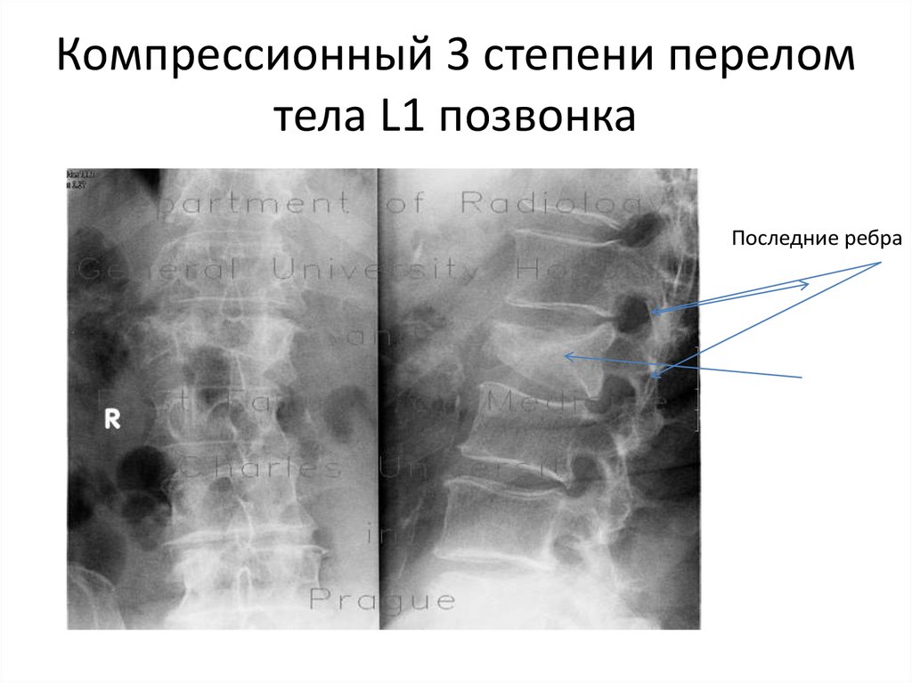 Компрессия тела позвонка