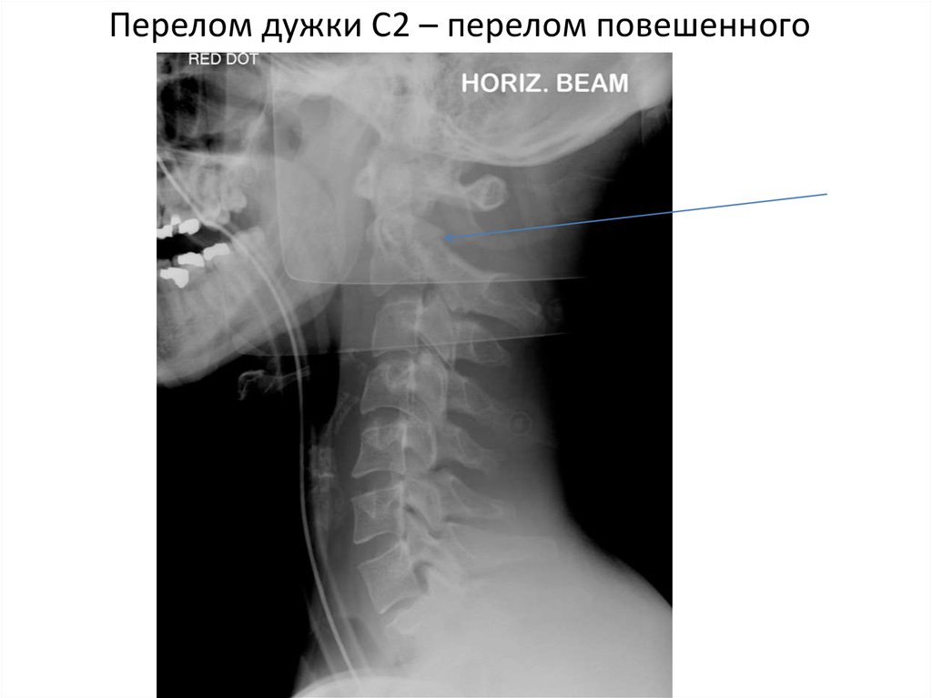 Перелом шейного позвонка. Перелом дужки позвонка c2. Перелом 2 шейного позвонка рентген. Перелом дужки позвонка рентген. Переломы дужек позвонков рентген.