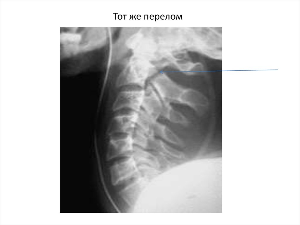 Переломы позвоночника презентация травматология