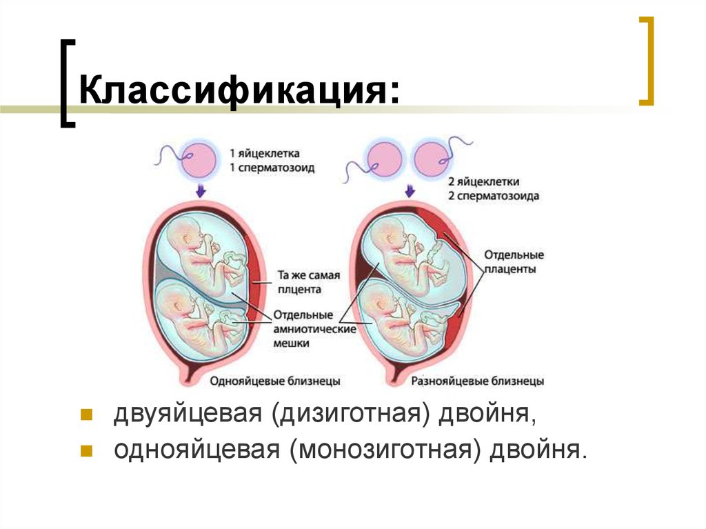 Многоплодная беременность презентация