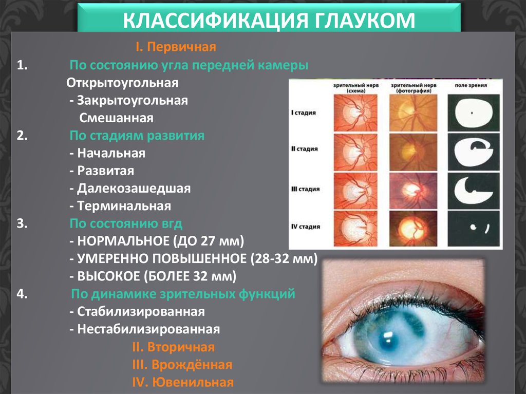 Классификация глаукомы. Закрытоугольная глаукома и открытоугольная глаукома. Классификация первичной открытоугольной глаукомы. Глаукома клинические рекомендации офтальмология. Стадии развития первичной открытоугольной глаукомы.