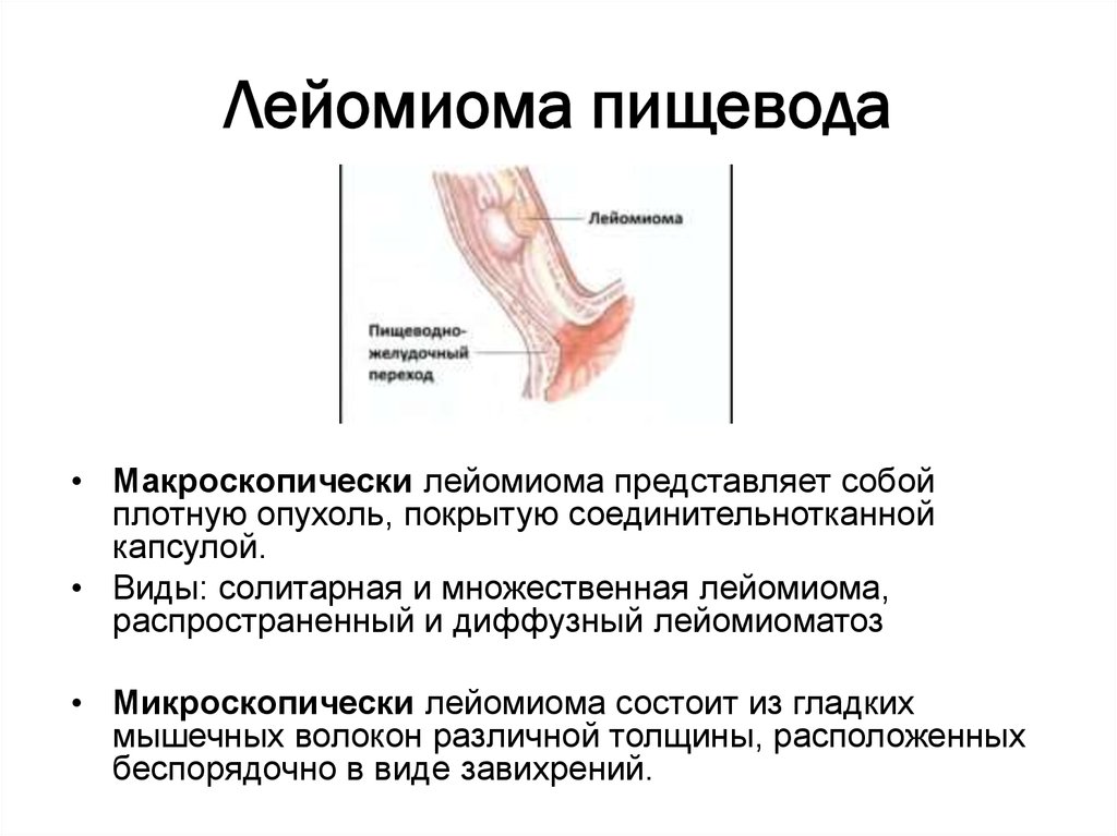 Пищевод лечение в домашних. Лейомиома желудка гистология. Рентген лейомиомы пищевода. Лейомиома средней трети пищевода схема. Форма опухоли пищевода.