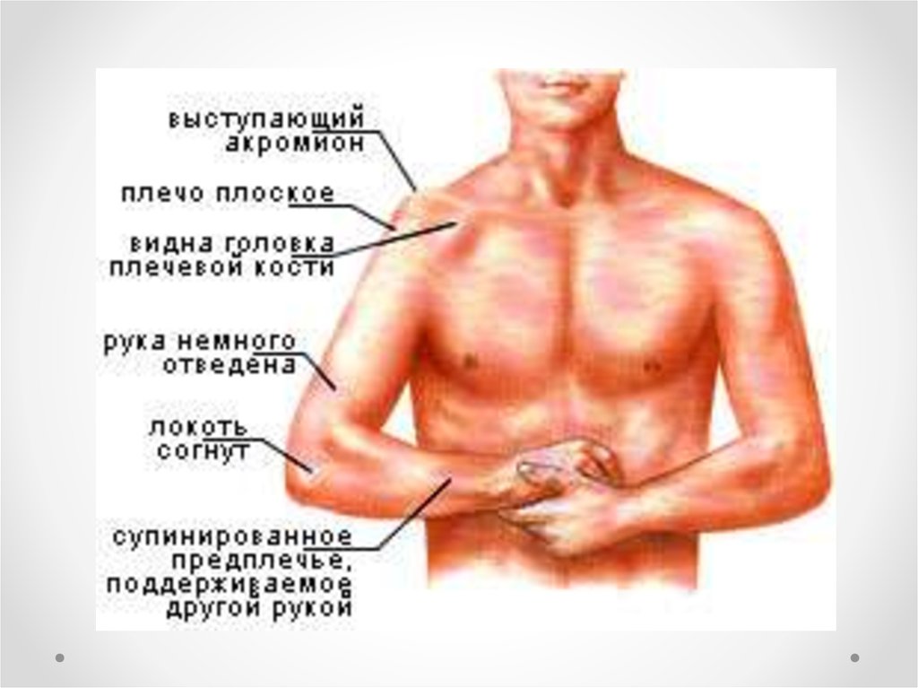 После операции болят плечи. Вывих плечевого сустава симптомы. Признаки вывиха плечевого сустава. Передний вывих плеча симптомы.