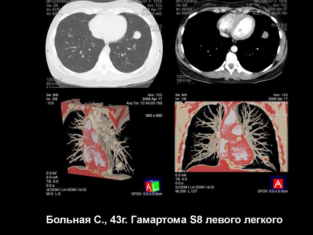 Презентация кт легких