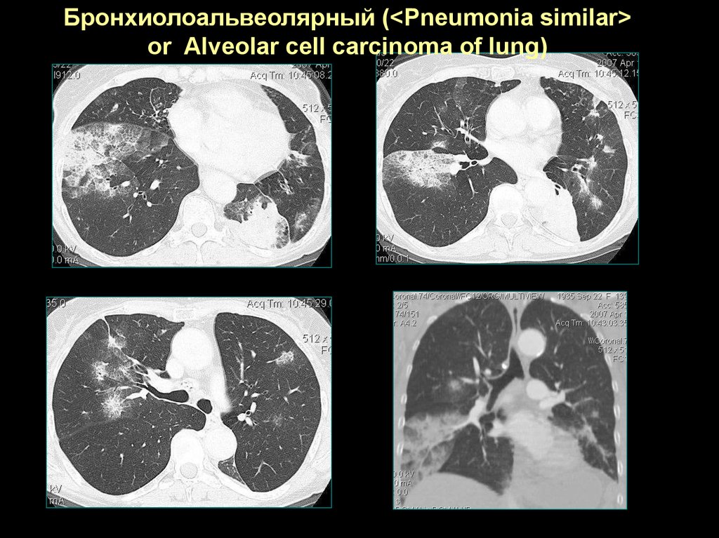 Бронхоальвеолярный рак презентация