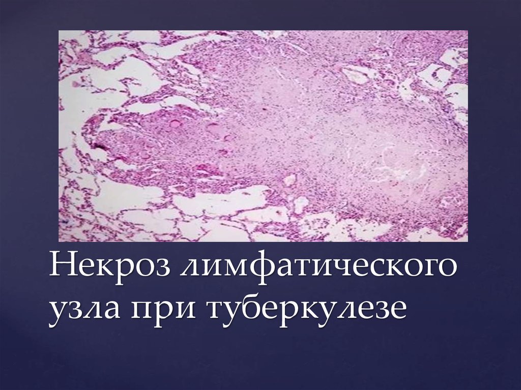 Некроз лимфатического узла при туберкулезе