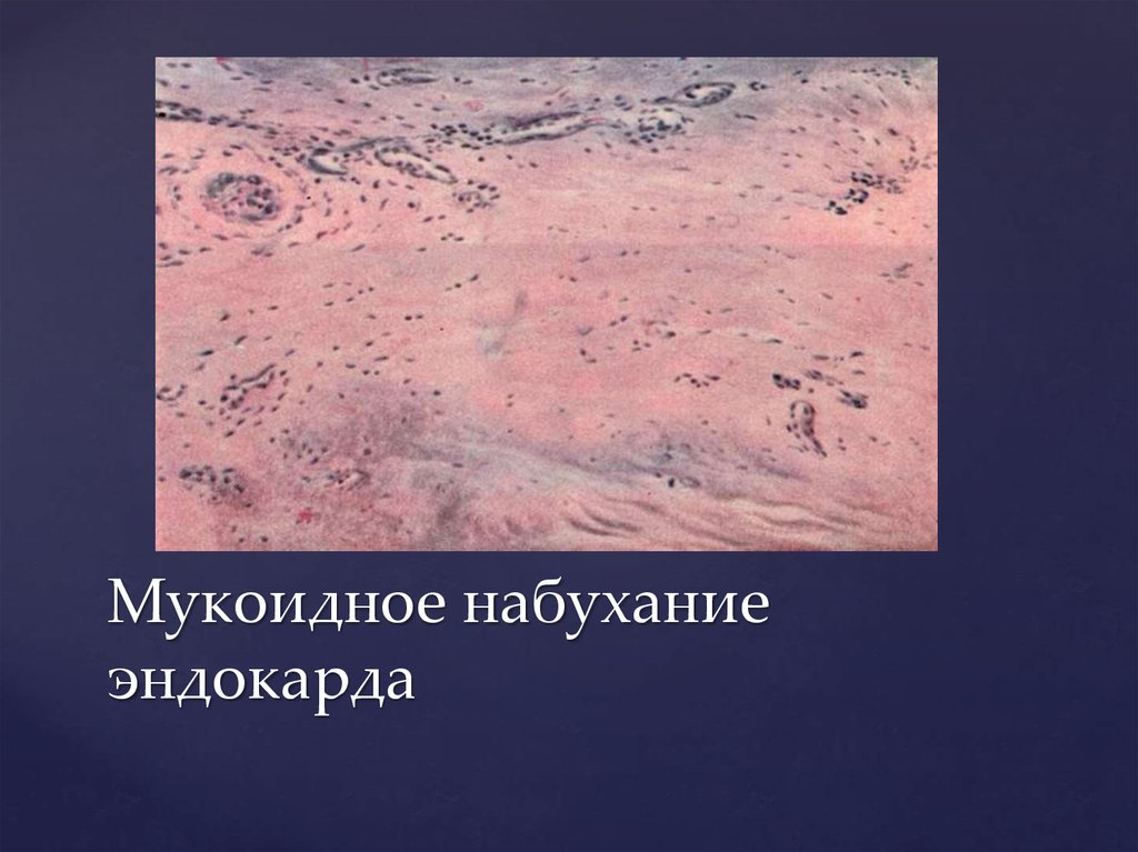 Мукоидное набухание макроскопическая картина