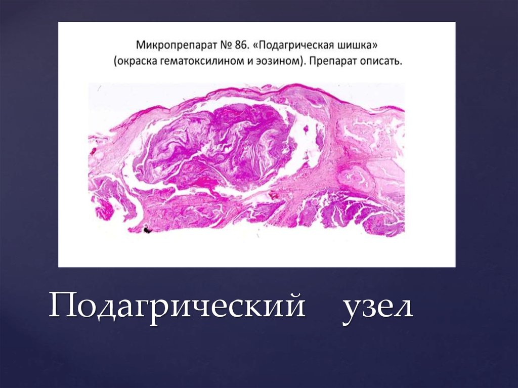 Трубная беременность микропрепарат. Микропрепарат подагра патанатомия. Подагрические узелки гистология. Подагра патоморфология гистология. Подагрический тофус гистология.