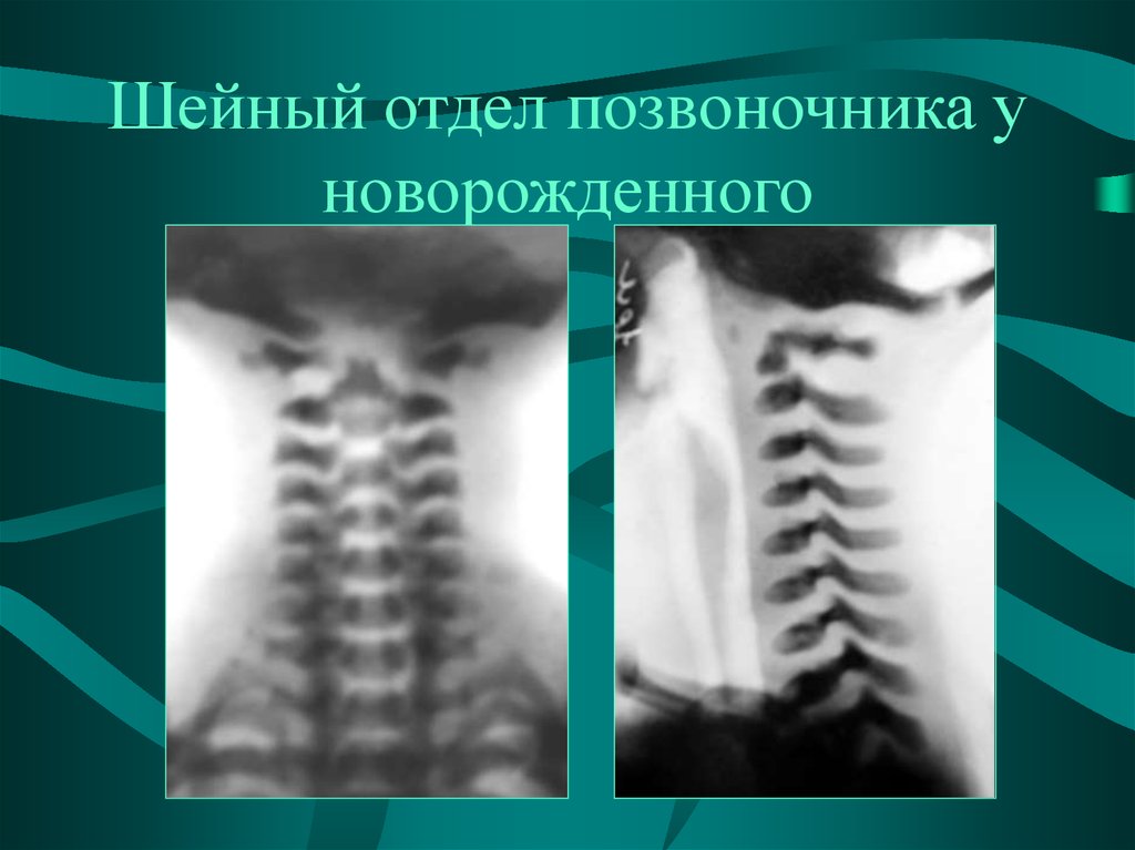 Повреждение шейного отдела позвоночника. Шейный отдел. Шейный отдел позвоночника новорожденного. Анатомия шейного отдела позвоночника у новорожденных. Шейный отдел позвоночника рентген анатомия.