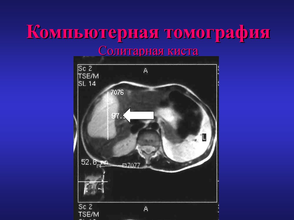 Простая киста печени при компьютерной томографии что это