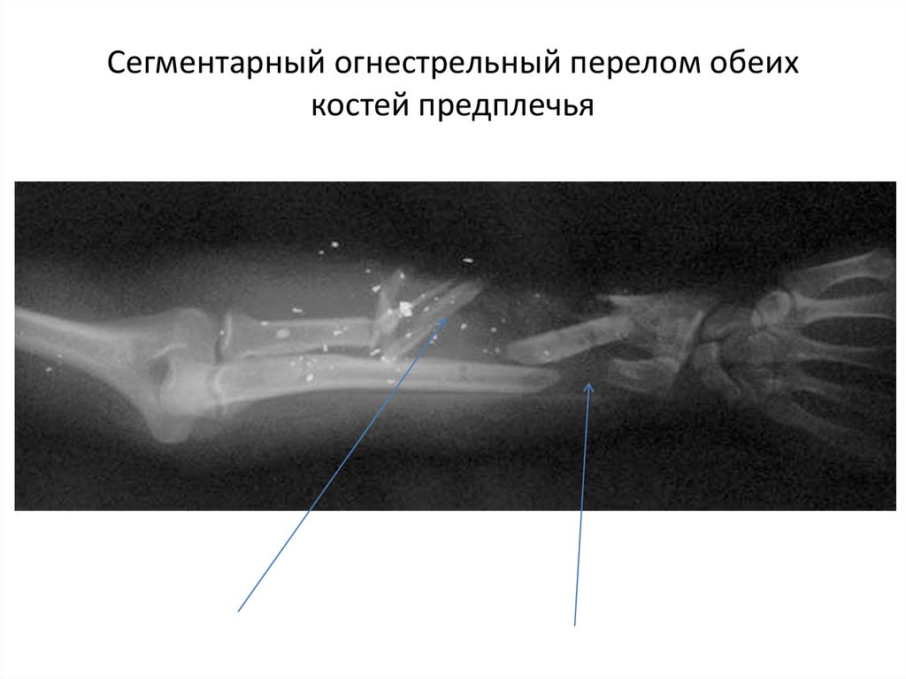 Перелом предплечья обе кости