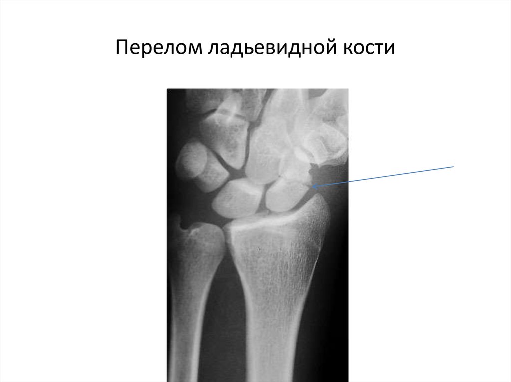 Лечение трещины кости