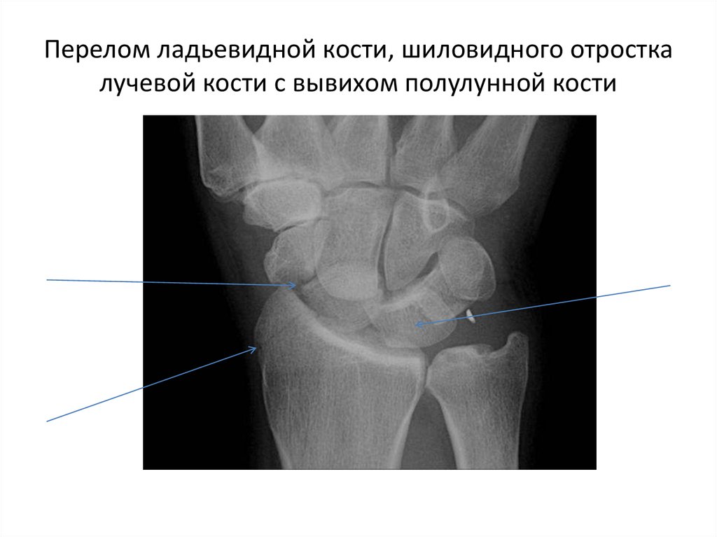Перелом шиловидного отростка локтевой кости. Перелом шиловидного отростка. Перелом шиловидного отростка лучевой кости. Перелом шиловидного отростка рентген. Краевой перелом шиловидного отростка локтевой кости.