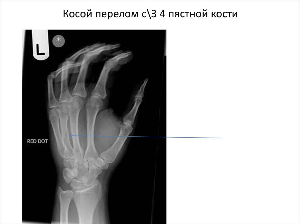 Повреждение предплечья презентация