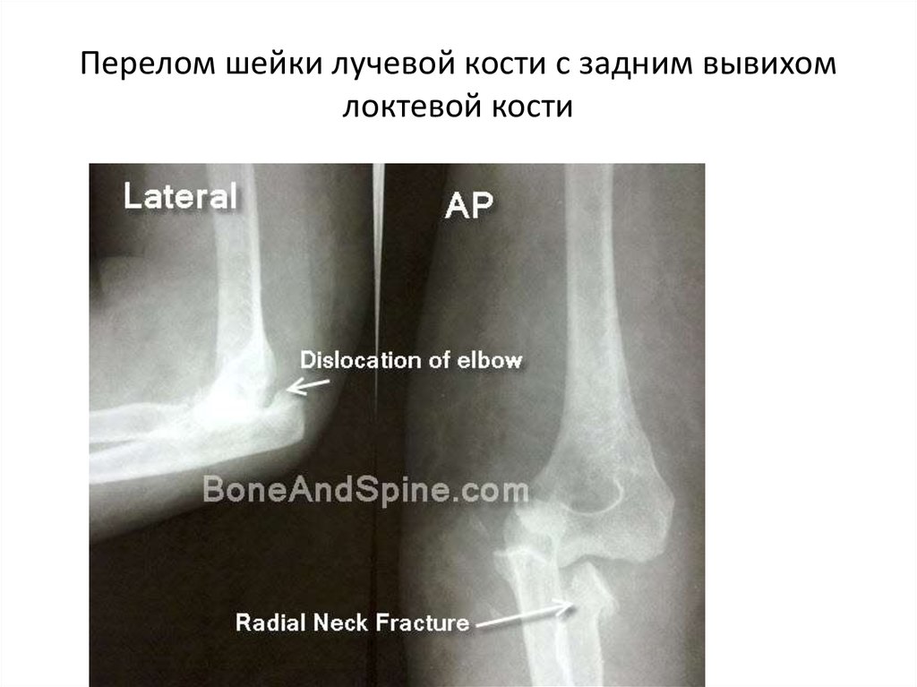 Перелом лучевой кости в локте