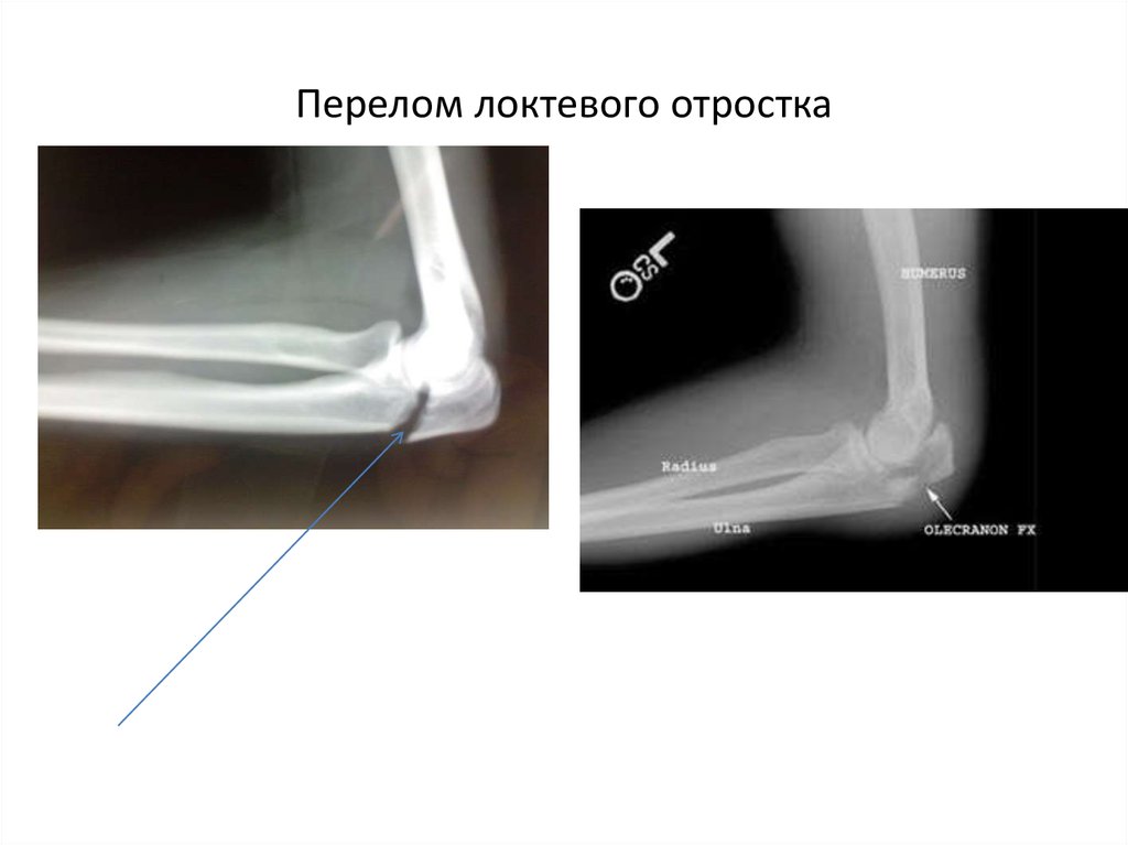 Перелом локтевого сустава карта вызова скорой медицинской