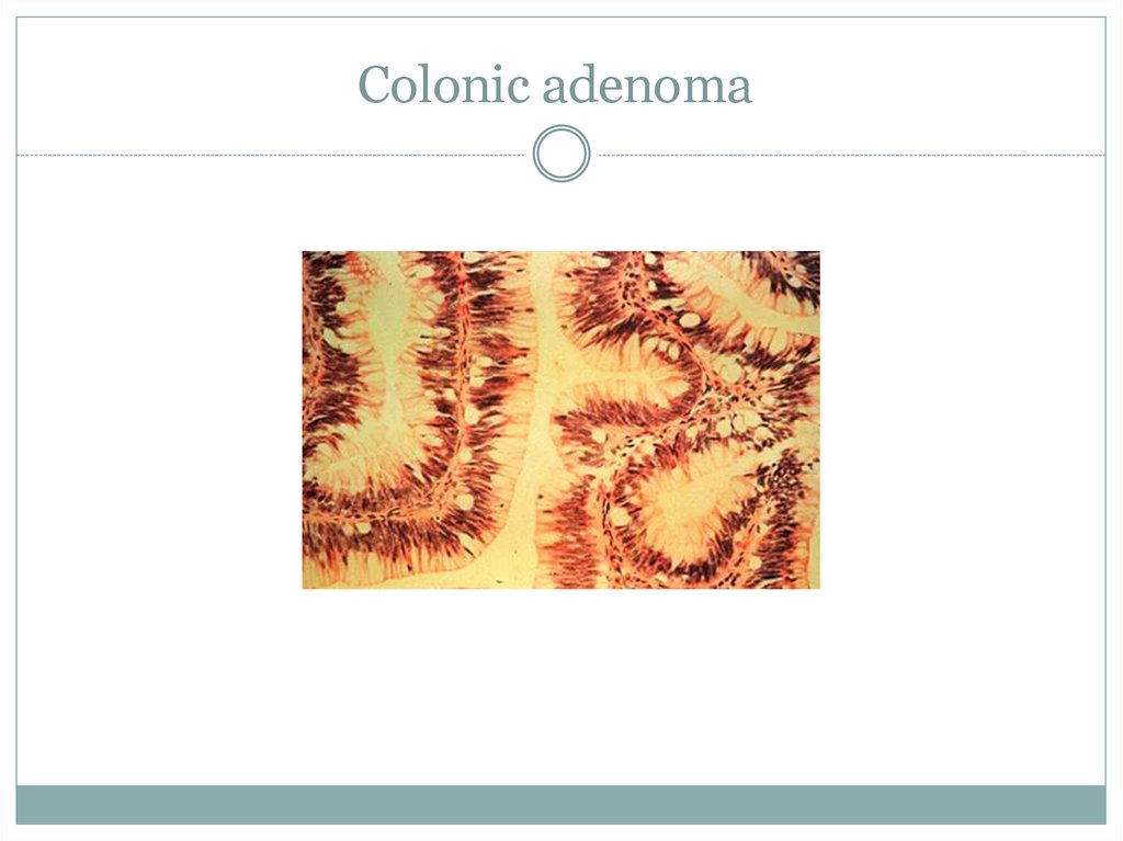 Colonic adenoma
