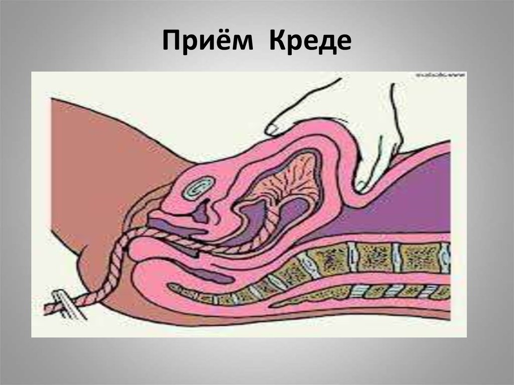 Внутри способ. Отделение последа гкреде Лазаревича. Абуладзе Гентера Креде-Лазаревичу. Прием выделения последа Креде Лазаревича.