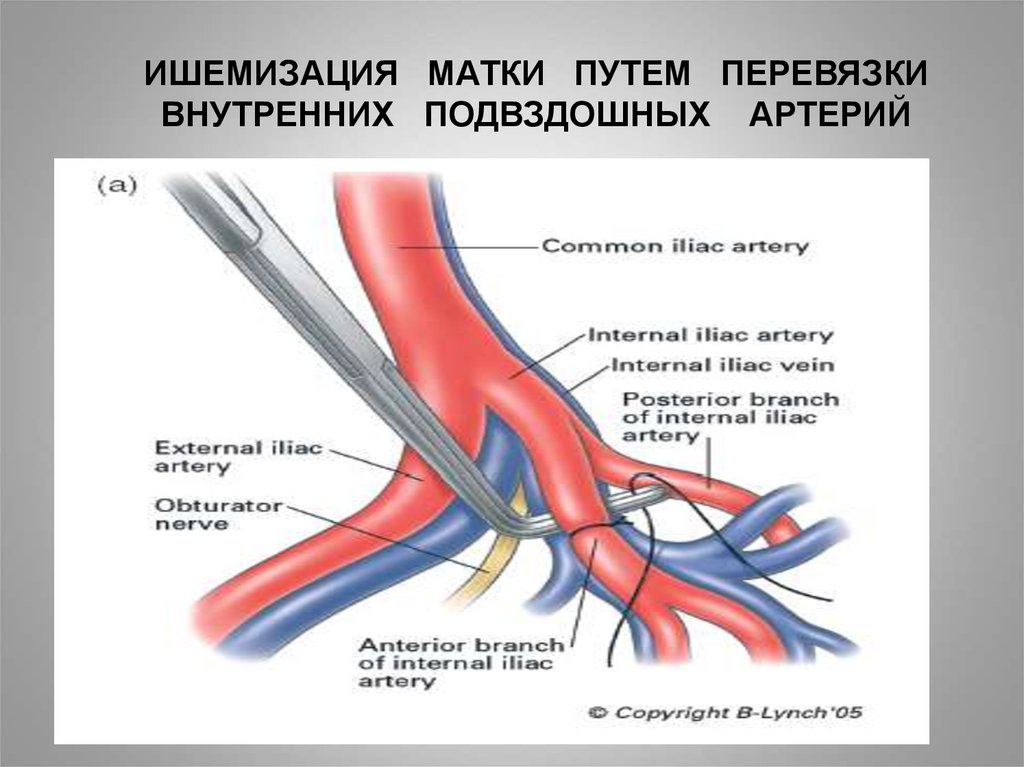 Экстравазальная компрессия артерий