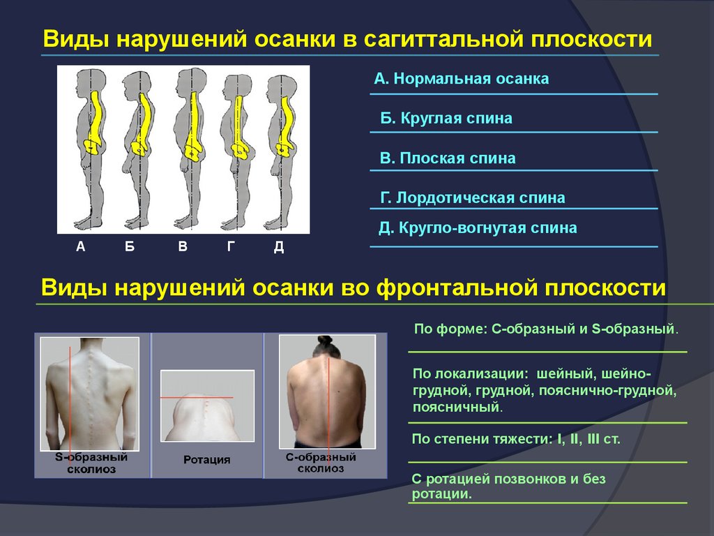 Фронтальная плоскость позвоночника. Тип осанки сагиттальная плоскость. Типы нарушения осанки. Типы нарушения осанки в сагиттальной плоскости. Тип осанки фронтальная плоскость.