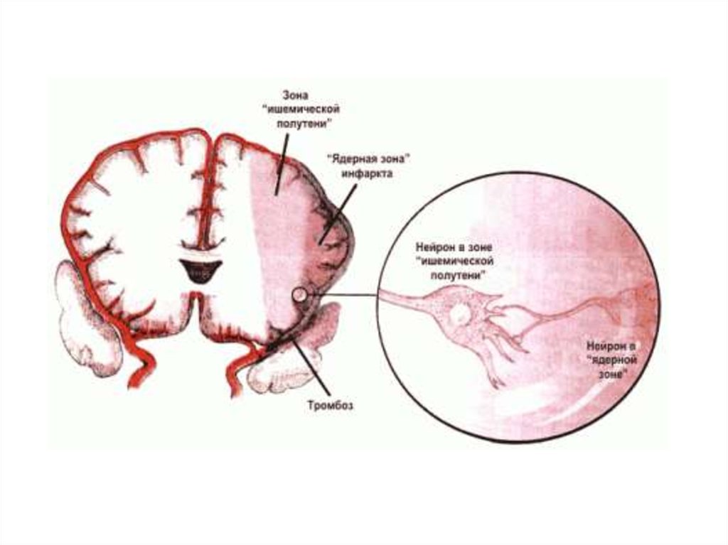 Ишемия мозга сколько живут. Патогенез хронической ишемии головного мозга. Ишемическое поражение мозга. Недостаточное кровоснабжение головного мозга. Зоны ишемии головного мозга.