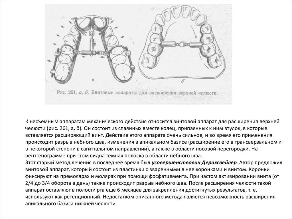 К несъемным аппаратам механического действия относится винтовой аппарат для расширения верхней челюсти (рис. 261, а, б). Он