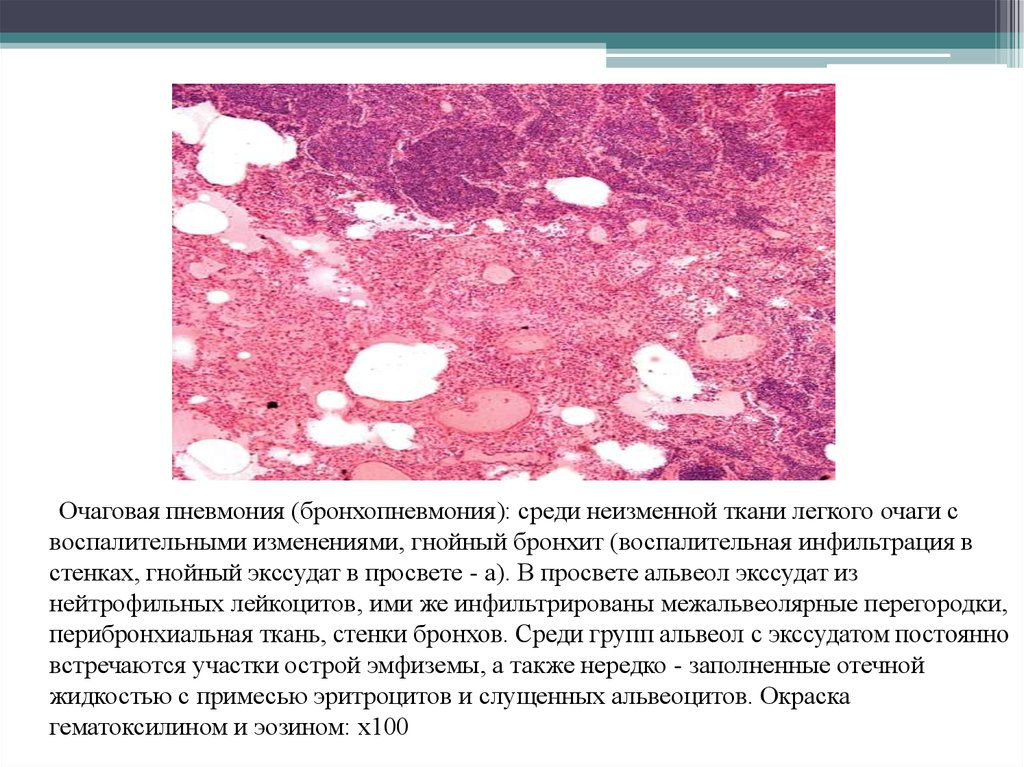 Пневмония микропрепарат описание. Гнойная пневмония патанатомия. Абсцедирующая пневмония гистология. Стрептококковая очаговая пневмония микропрепарат. Бронхопневмония патанатомия препарат.