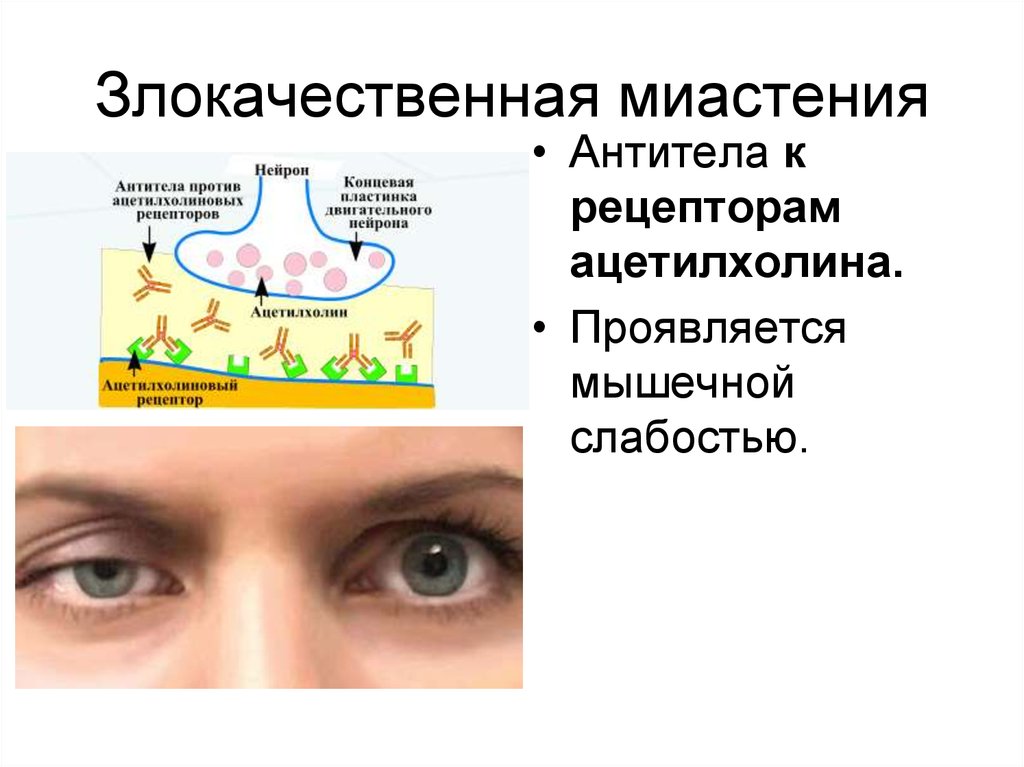 Клиническая картина миастении