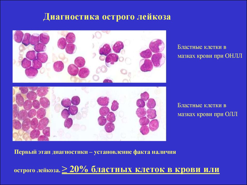 Диагноз острая кровь. Бластные клетки в крови при лейкозе. Изучение мазков крови при остром лейкозе.. Бластные клетки мазок крови. Острый лейкоз мазок крови.