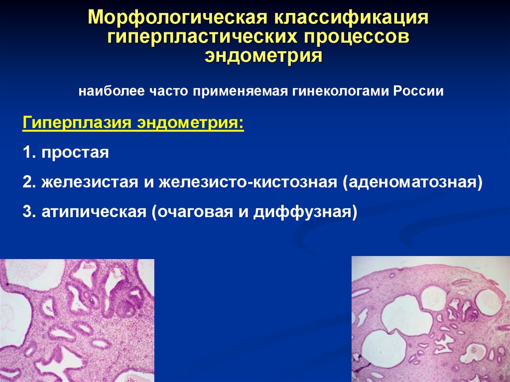 Гиперплазия эндометрия проходит. Атипическая гиперплазия эндометрия полипоз. Железистая гиперплазия эндометрия гистология. Атипическая гиперплазия гистология. Железистая гиперплазия эндометрия гистология классификация.