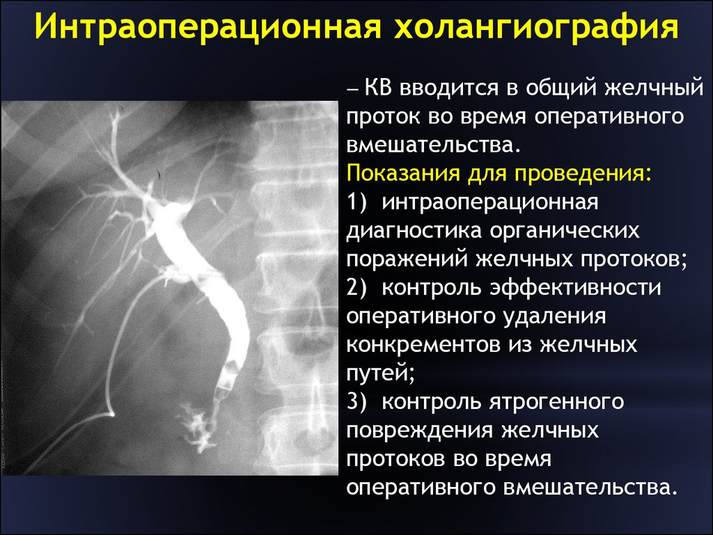 Описание причины. Холангиография желчных протоков рентген. Фистулография желчных протоков рентген. Стриктура холедоха рентген. Рентген желчного протока.