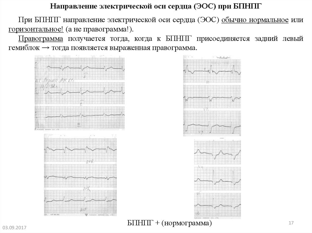 Нарушение внутрижелудочковой проводимости на экг. ЭОС правограмма. Правограмма на ЭКГ. ЭОС при блокаде правой ножки пучка Гиса. ФВ ЭОС.