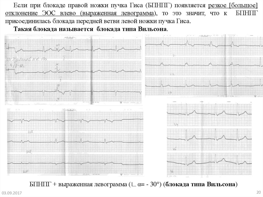 Блокада правой ножки на экг. Неполная блокада левой ножки пучка Гиса ЭКГ критерии. Блокада передней ветви правой ножки пучка Гиса. ЭОС при блокаде правой ножки пучка Гиса. ЭОС при блокаде левой ножки пучка Гиса отклонение.