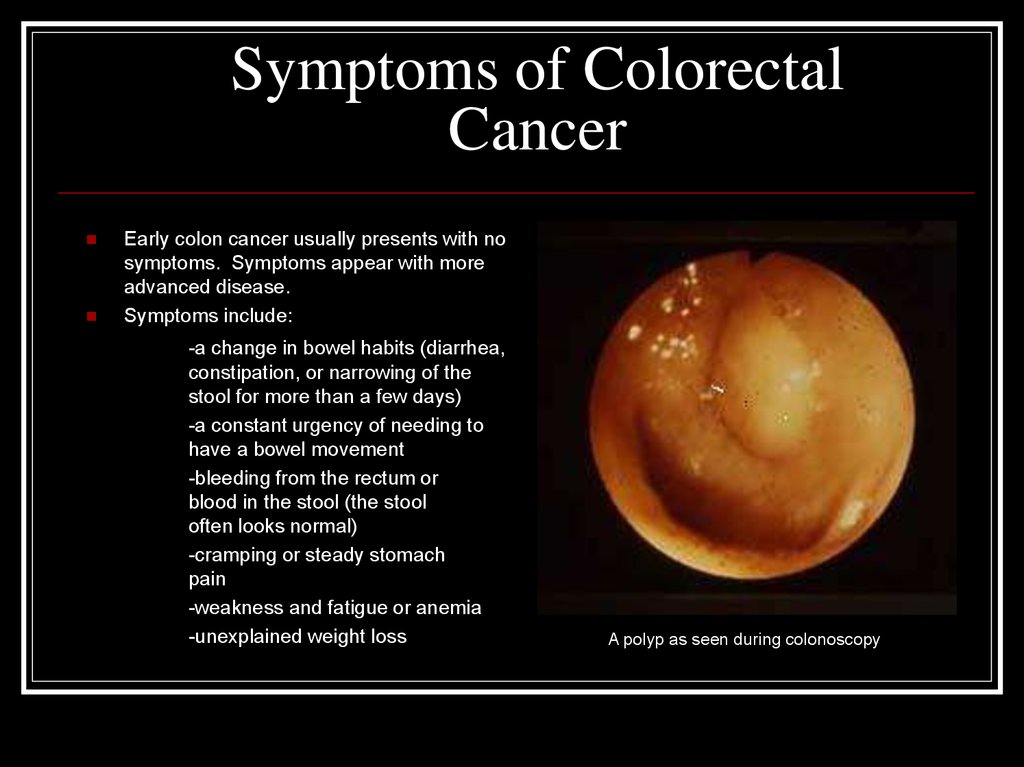 Colon Cancer Bleeding Stool : Colorectal Cancer Digestive Disorders ...