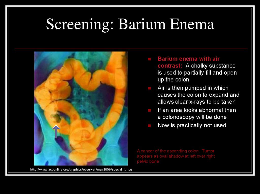 Screening: Barium Enema
