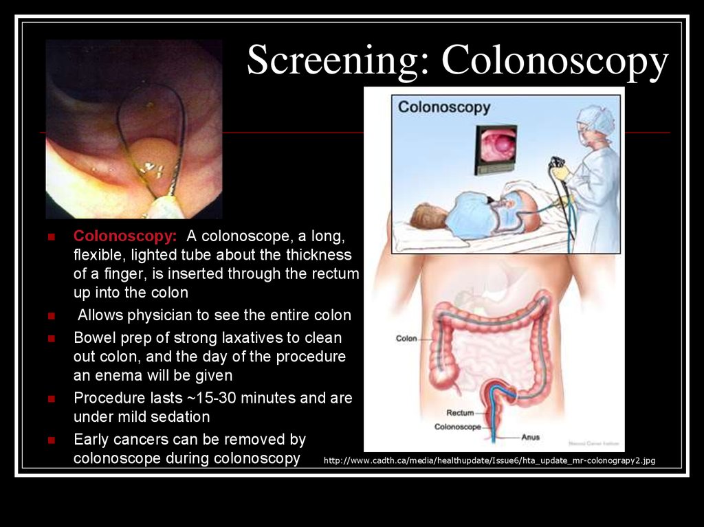 Screening: Colonoscopy