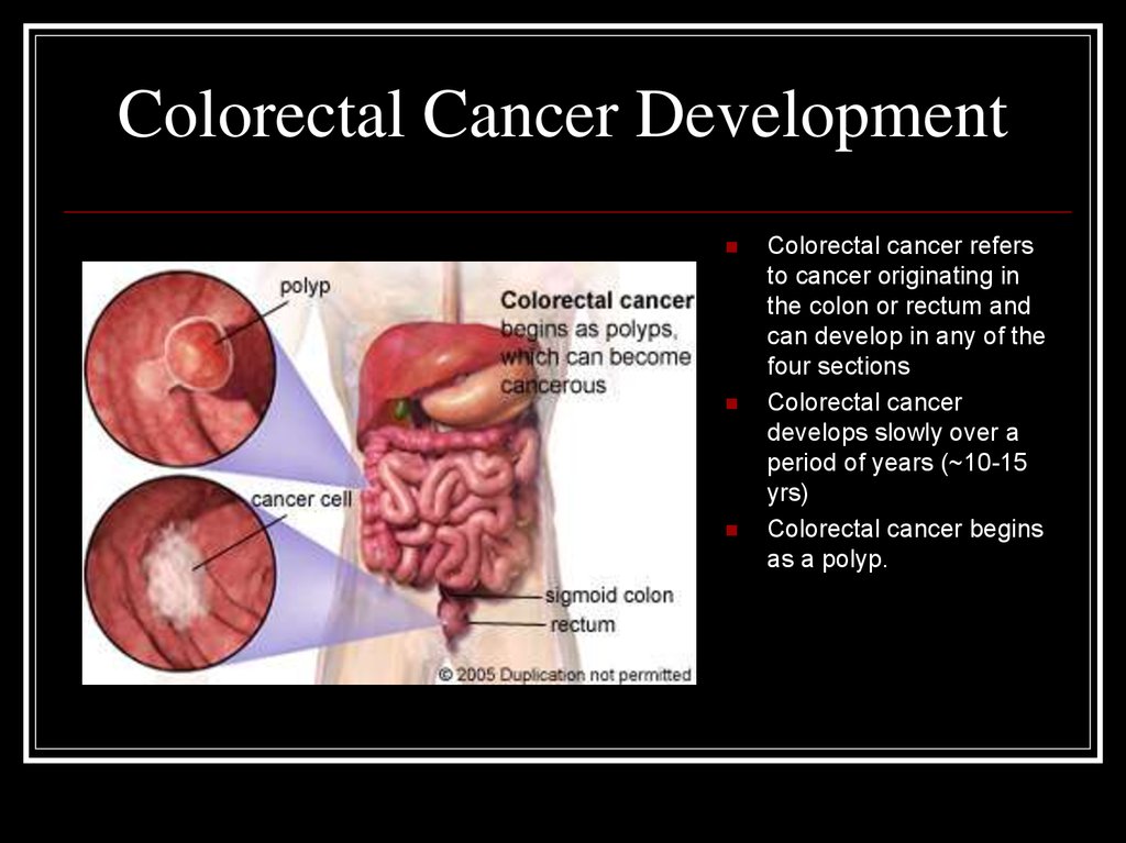 Colorectal Cancer - презентация онлайн