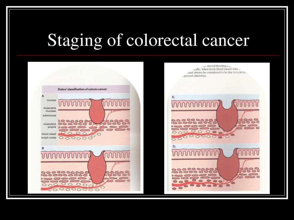 Colorectal Cancer - online presentation