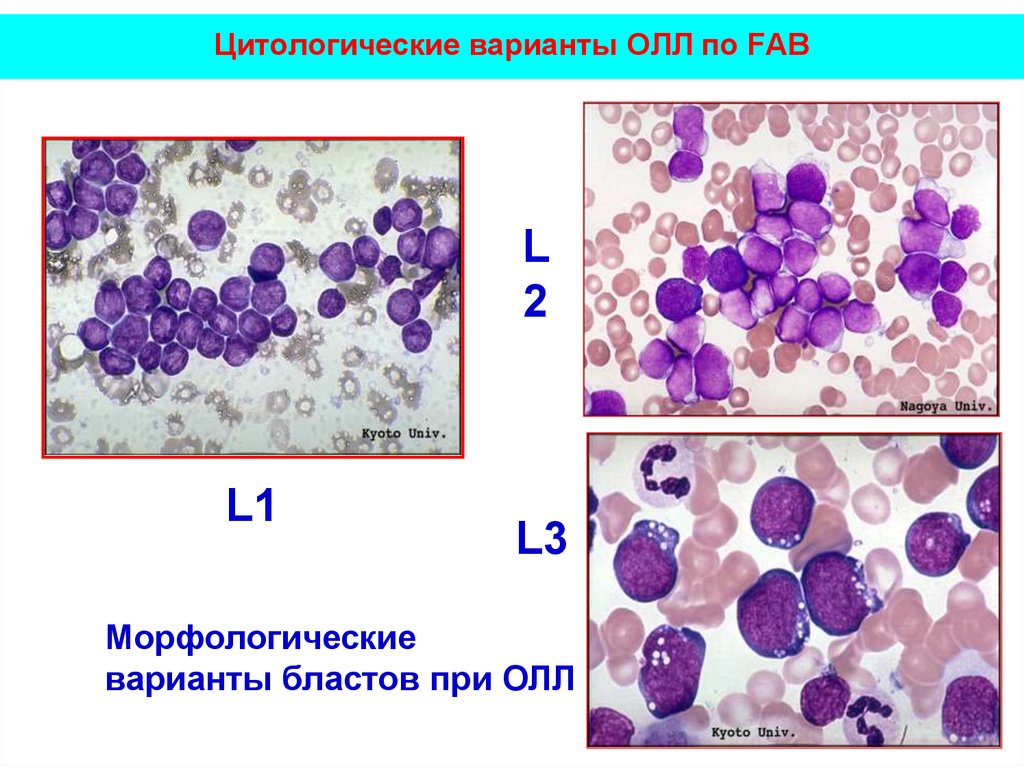 Острый лимфобластный лейкоз. Острый лимфобластный лейкоз l1. Острый лимфобластный лейкоз l2. Лимфобластный лейкоз миелограмма. Острый лимфобластный лейкоз oll.