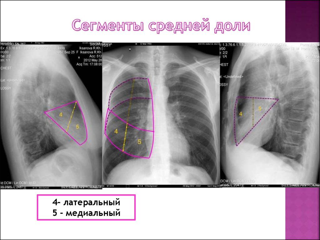 Ателектазы рентген схема